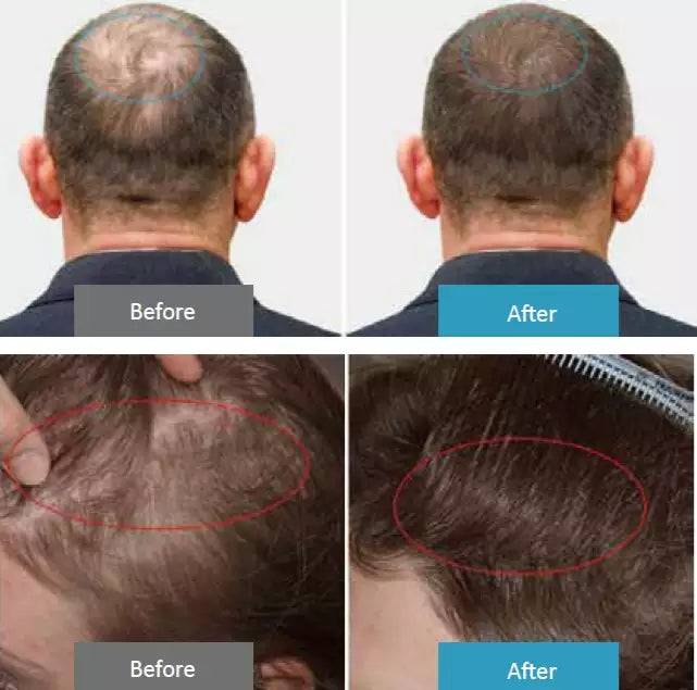 HD-CurePro  - Handheld Compound Laser Device for Pain Relief and Hair Growth