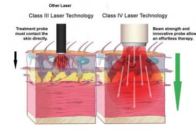 HD-CureX (Class IV laser)