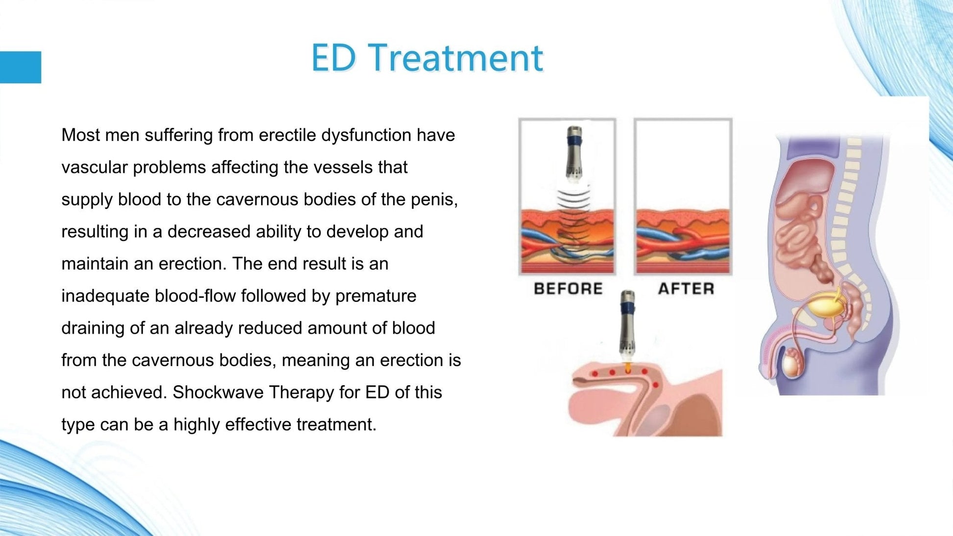 Uno Vita Focus Shockwave System (ED)